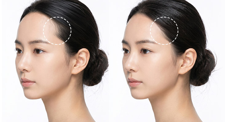 측면을 고려한 모제림 헤어라인 교정