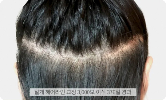 절개 헤어라인 교정 수술 후 1년 경과