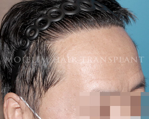 수술 후