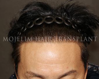 60대 수술 후 3