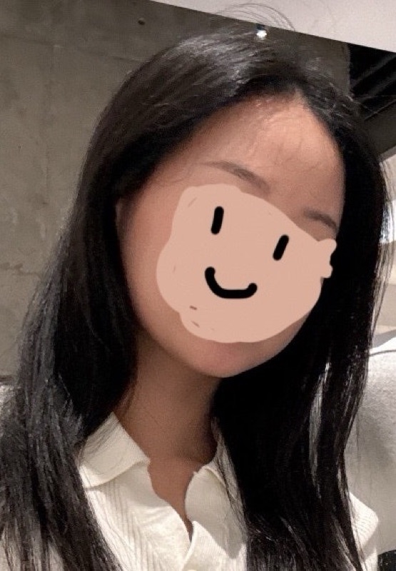 모발이식한지 1년 지났어요
