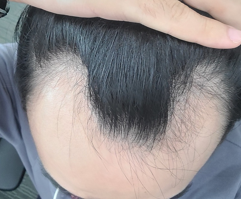 30대 5일차 이식 후기