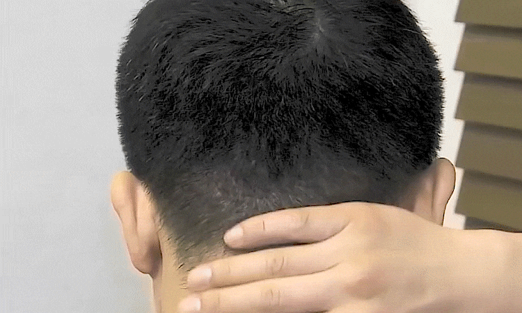 모제림 비절개 수술 후 1년 경과