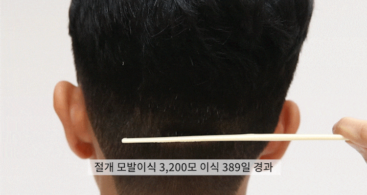 절개 모발이식 수술 후 1년 경과